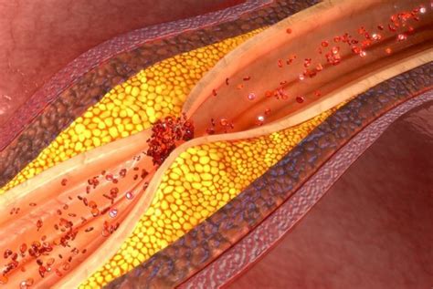 Symptoms and Treatments of Vertebral Artery Occlusion - Health & Detox ...