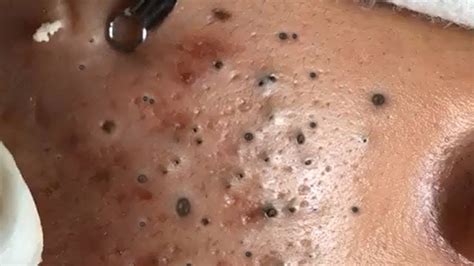 Big Cystic Acne Blackheads Extraction Blackheads & Removal Pimple ...