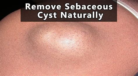 Remove Sebaceous Cyst Naturally at Home (Fast and Easy) | Home remedies ...