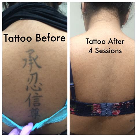 Awesome Tattoo Removal Cost Atlanta 2024 - spaceheaters.us