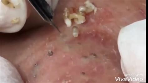 Blackhead Popping Pimple On Back