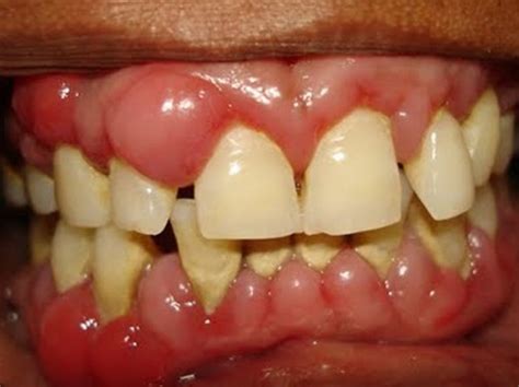 Does Heat Help Swollen Gums at nancylrogers blog