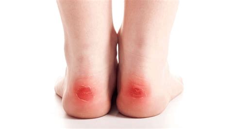 Blisters: Treatment & Prevention | The Feet People Podiatry