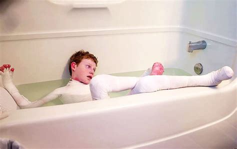 Butterfly Boy Jonathan Pitre's skin falls off with the slightest touch