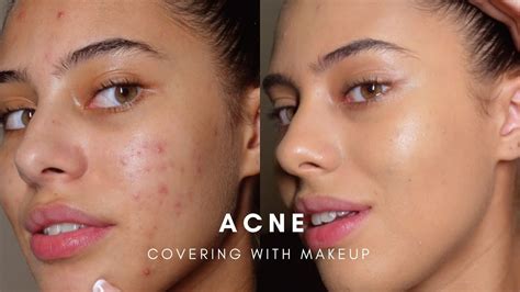 Acne Covered With Makeup Meme | Makeupview.co