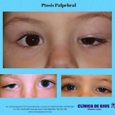 Clínica de Ojos Oftalmic Láser: Ptosis palpebral