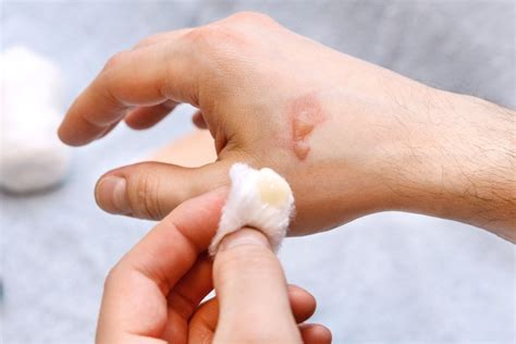 Management of Burn Blisters in Urgent Care - Journal of Urgent Care ...