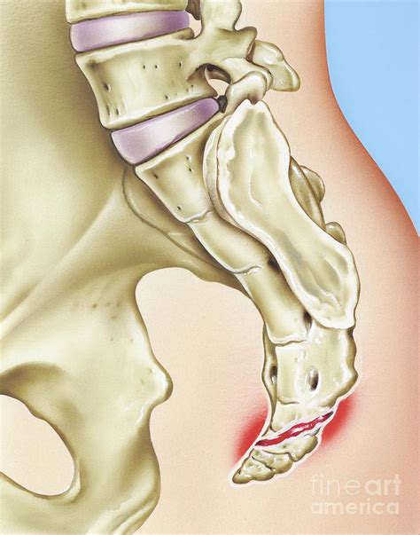 Coccyx Bone Fracture