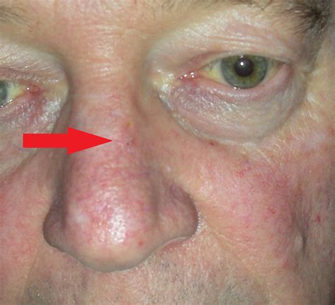 Signs Of Skin Cancer Nose at Arthur Bingham blog