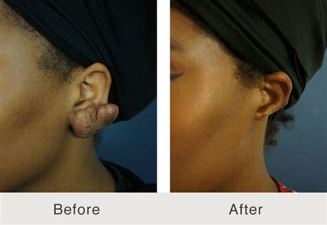 Keloid Removal - Carolina Facial Plastics