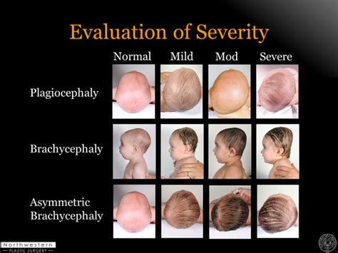 Head Shape Evaluation Clinic - Childrens Faces