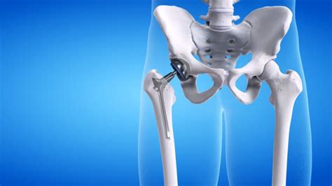 Hip replacement surgery: Here's what you need to know | Intellijoint ...