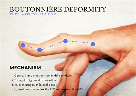 Swan Neck Deformity vs Boutonnières