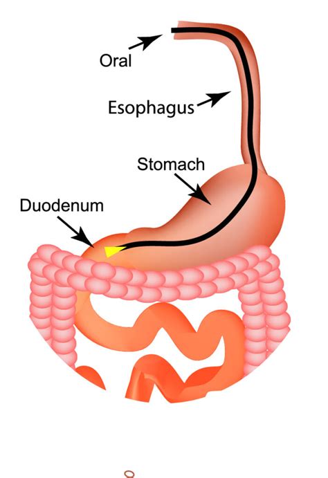 Upper Endoscopy/EGD (Esophagogastroduodenoscopy) | USDH