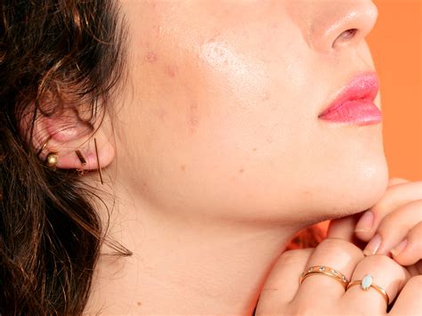 Hormonal Acne: What It Is And Why It Happens Columbia Skin Clinic ...