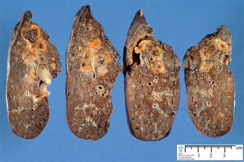 Cystic Fibrosis Lungs Pictures