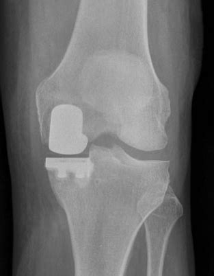 Uni Knee replacement: why, advantages, operation, FAQ | uni-knee.com