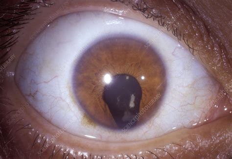 Coloboma of the eye - Stock Image - C054/6314 - Science Photo Library