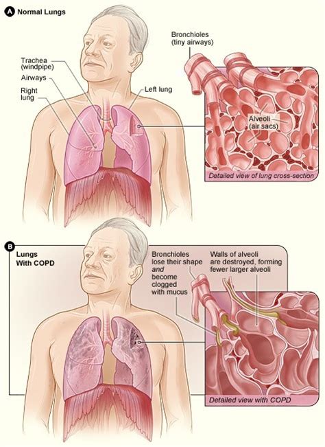 End Stage Lung Disease - Newport Cardiac & Thoracic Surgery