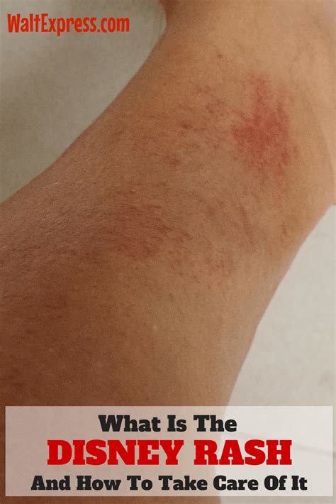 What is the Disney rash and how to take care of it? | Disney rash ...