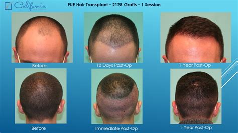 35+ Fue Hair Transplant Recovery Timeline - FergusAshley