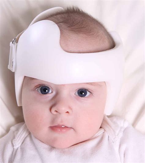 Baby Flat Head Syndrome (Plagiocephaly): Causes & Treatment