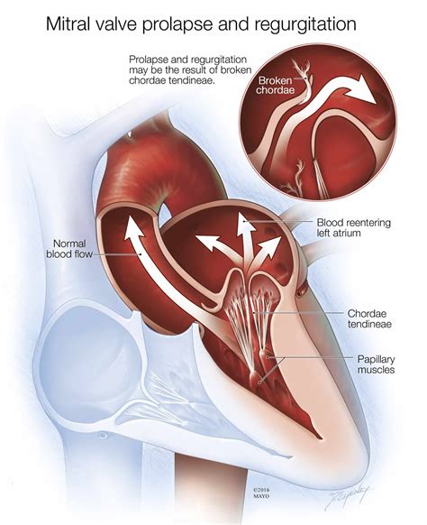 Mitral Valve | Images and Photos finder