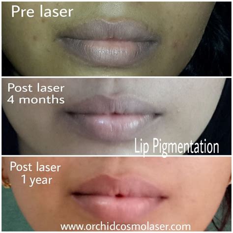 Before / After Images of pigmentation treatment | Orchid Cosmo laser