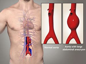 Abdominal Aortic Aneurysm Endovascular Repair Treatment Sydney