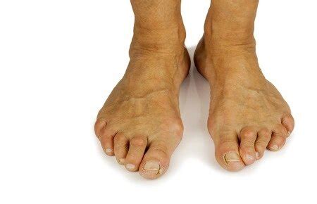 Common Foot Deformities — Advanced Feet & Ankle Care