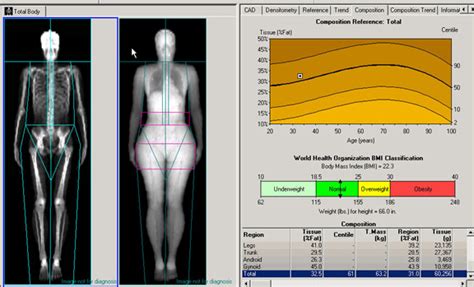 Bone Density Scan (DEXA) | Rowe Creavin Medical Practice