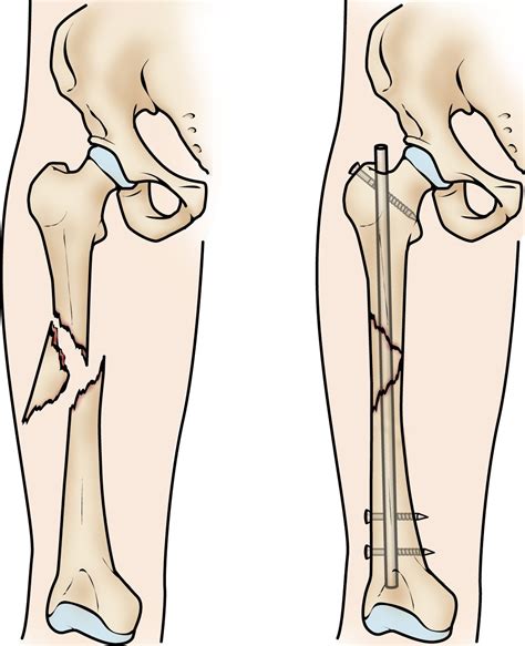 Femur Shaft Fractures (Broken Thighbone) - OrthoInfo - AAOS