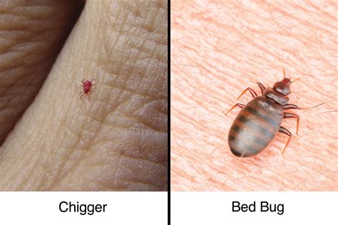 Chigger Bites Vs Bed Bug Bites How To Tell The Difference The He ...