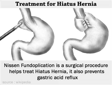 Hiatus Hernia - Types, Causes, Symptoms, Complications, Diagnosis ...