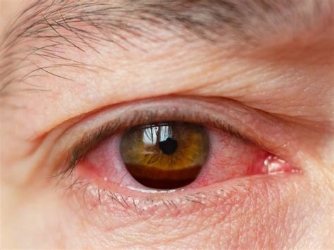 Hyphema (Bleeding in Eye): Diagnosis, Symptoms & Causes