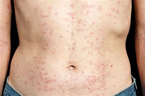 Bacterial Fungal Skin Rash