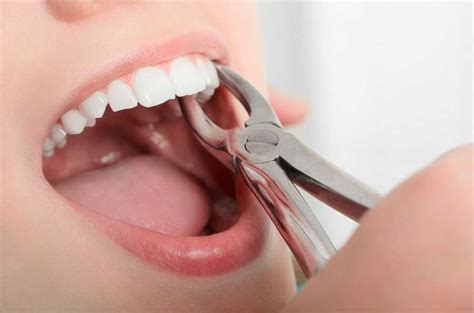 How to Prepare for a Tooth Extraction