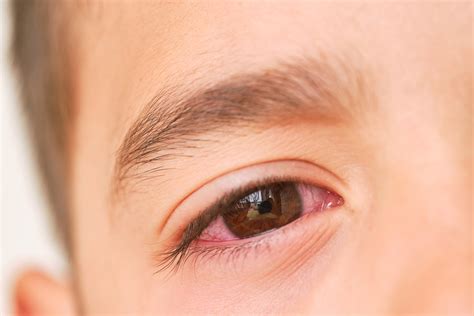 Three Types of Pink Eye and How to Prevent it | University of Utah Health