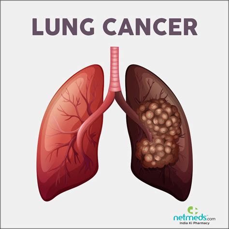 Lung Cancer: Causes, Symptoms And Treatment | Netmeds