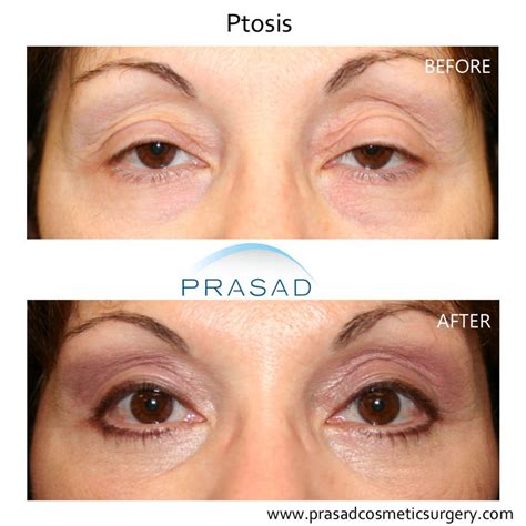 Ptosis Droopy Eyelid Causes Droopy Eyelid Treatment And Ptosis Surgery ...