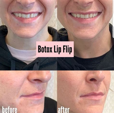 Botox Lip Flip