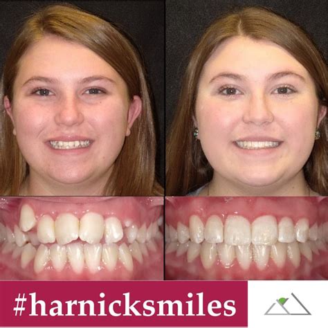 Harnick Orthodontics | Albuquerque Braces & Invisalign | Results