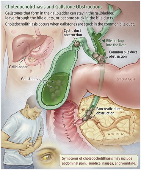 Choledocholithiasis | Medical knowledge, Medical education, Medical ...