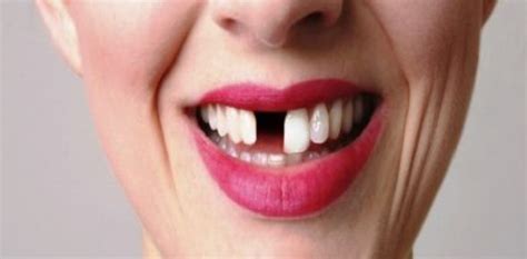 8 Common Causes Of Missing Teeth In Adults – Mojo Health