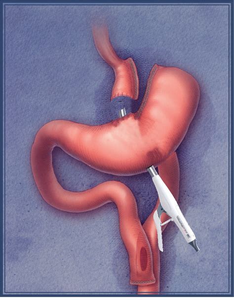 Figure 1 from Duodenal switch with omentopexy and feeding jejunostomy ...