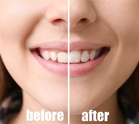 Gingivectomy/Gingivoplasty - Luna Dental McAllen Texas