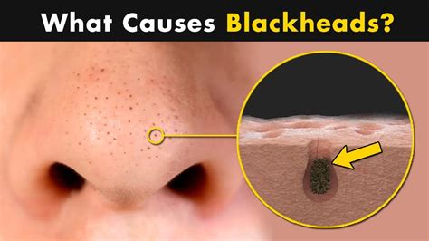 What Causes Blackheads on Our Skin? | Symptoms, Causes And Treatment ...