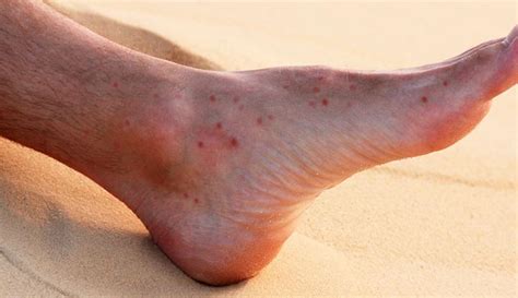 Sand Flea Bites: What They Look Like, Treatment & Prevention