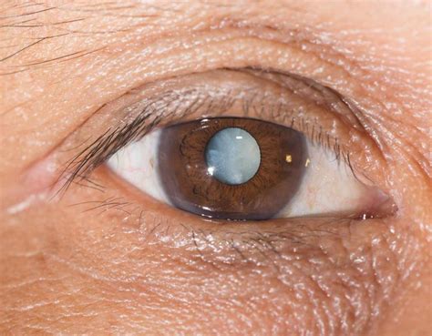 Symptoms of Cataracts | London Cataract Centre