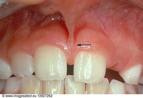 High Attachment of the Maxillary Labial Frenum High Attachment of the ...